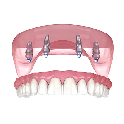 Removable Snap-on Dentures