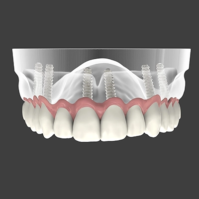 All-On-6 Implant