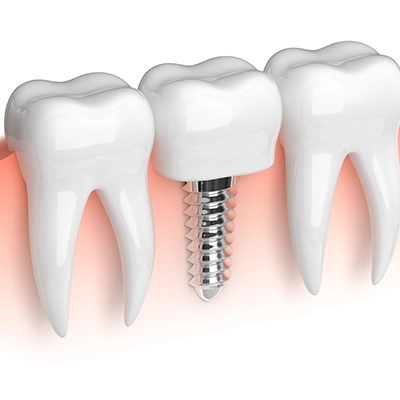 Dental Implant Type