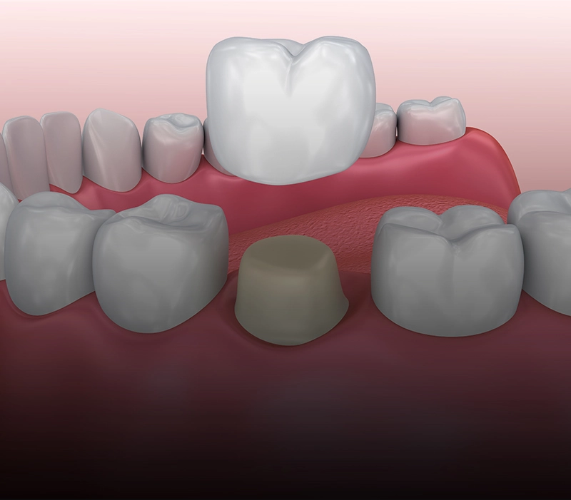 dental crown (4)