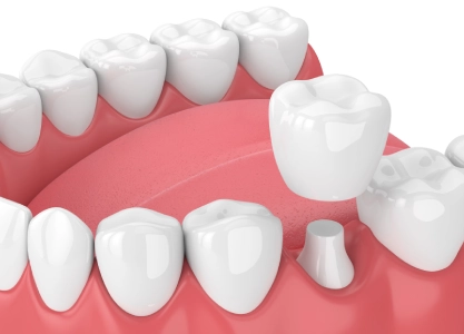 Temporary vs Permanent Dental Crown